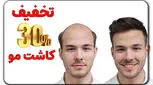 تخفیف ویژه کاشت مو | فرصتی استثنایی برای داشتن موهایی زیبا