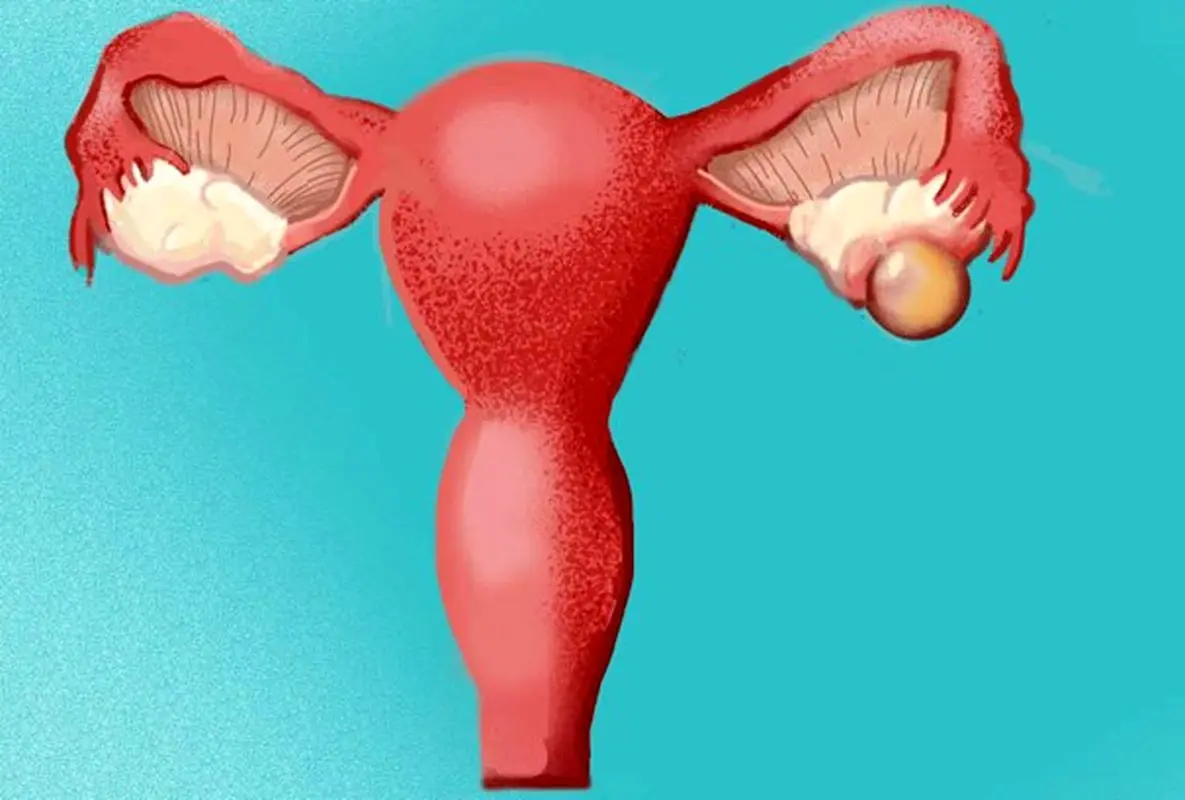 پریود نامنظم و کیست تخمدان چه ارتباطی دارند؟