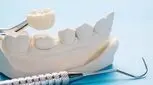 قیمت روکش دندان در سال 1404 چقدر است؟