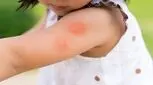 حشره‌گزیدگی در کودکان؛ این نشانه‌ها زنگ خطرند