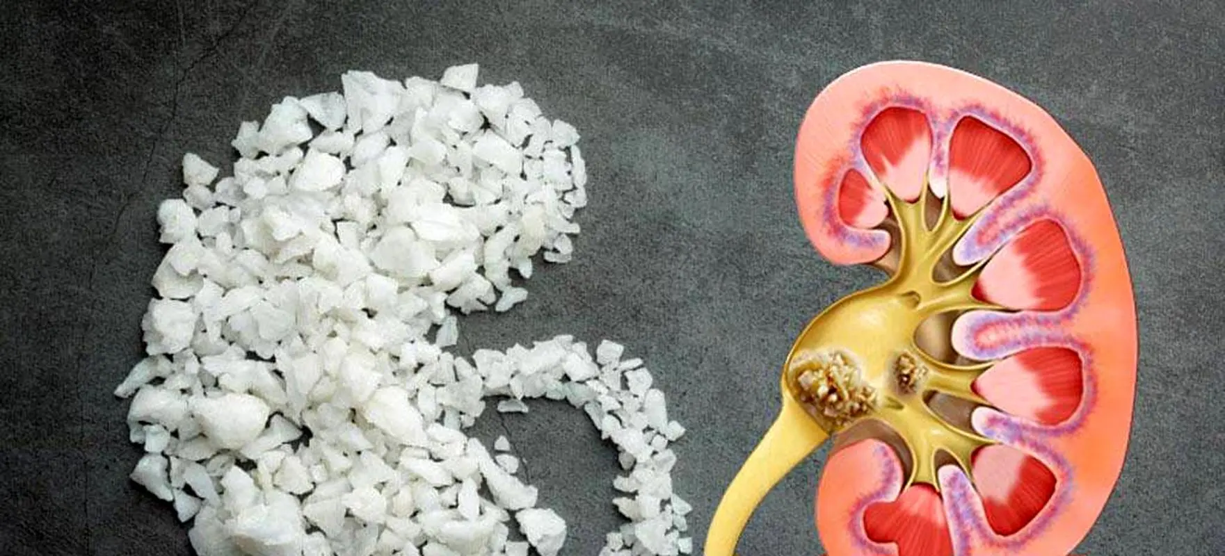 سنگ کلیه دارید؟/ این میوه‌ها را مصرف کنید 