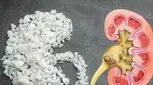 سنگ کلیه دارید؟/ این میوه‌ها را مصرف کنید 