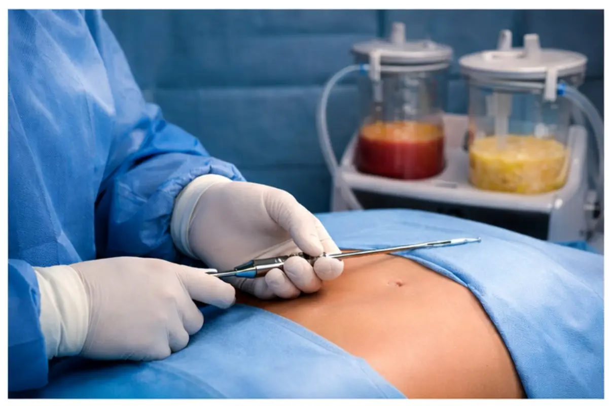 مرکز لیپوماتیک در شرق تهران + معرفی 10 مرکز برتر