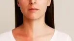 سفید کردن پوست آفتاب سوخته چگونه است؟ 9 راهکارهای خانگی و دارویی آفتاب سوختگی