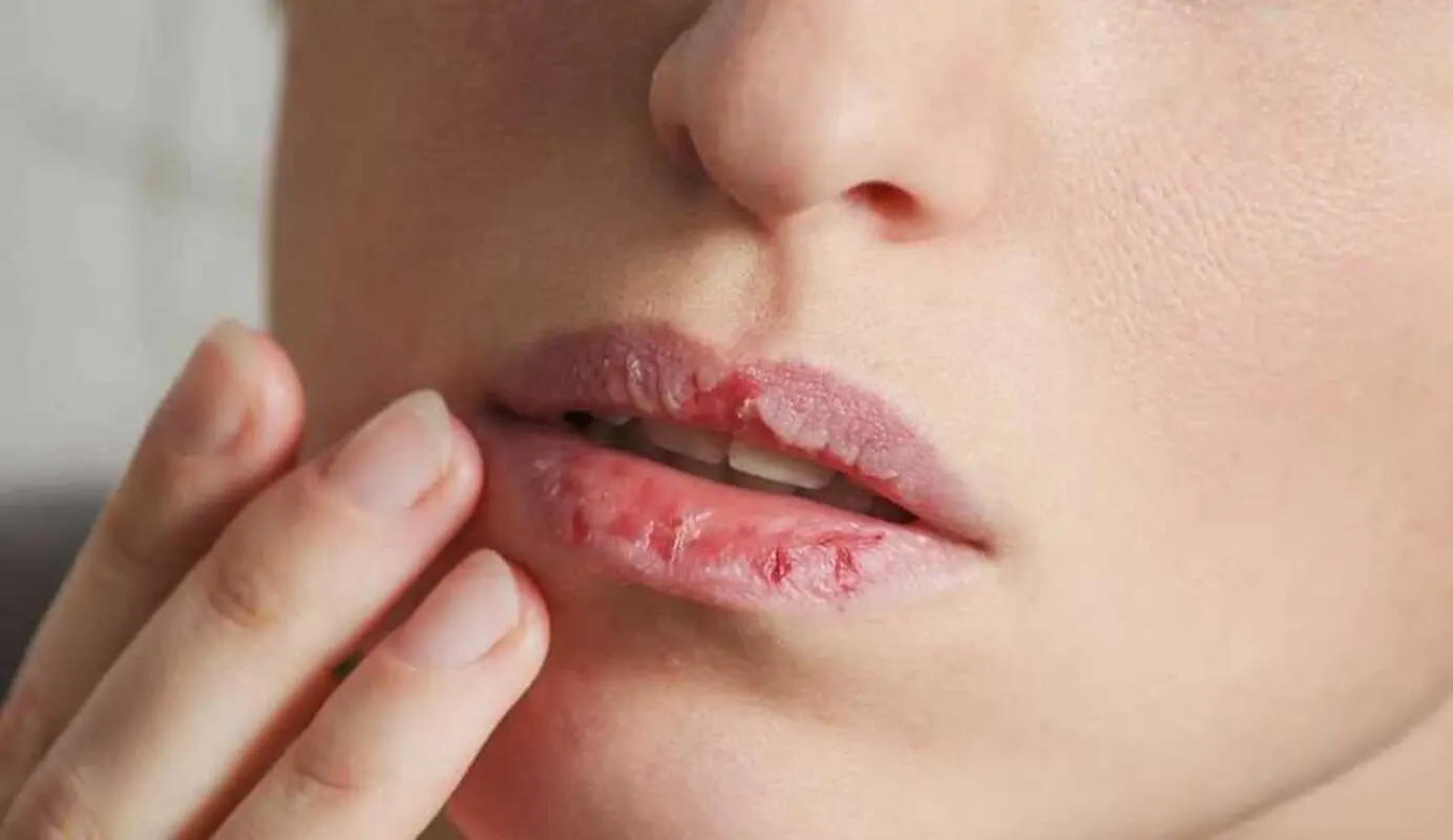 چند راهکار برای پیشگیری از خشکی و ترک لب‌ها در رمضان
