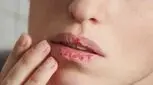 چند راهکار برای پیشگیری از خشکی و ترک لب‌ها در رمضان