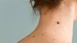 خال سرطانی چه رنگی است؟

