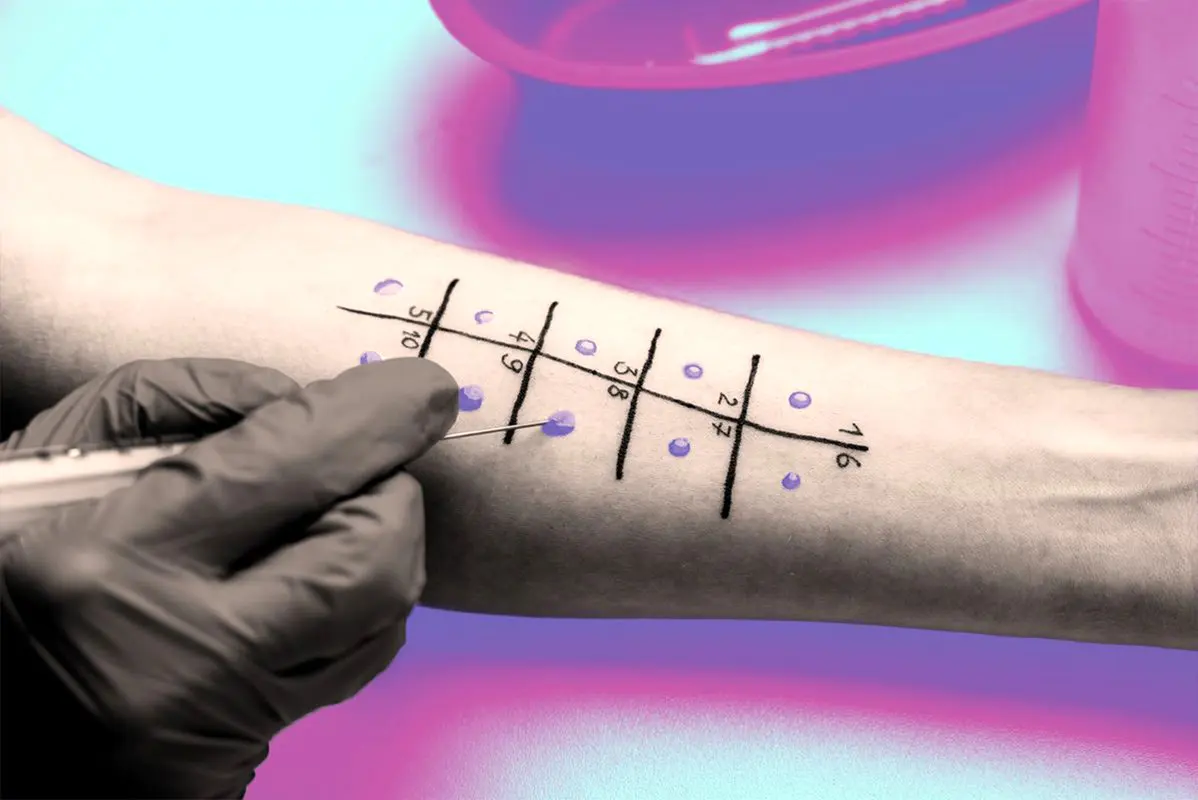 انجام تست آلرژی