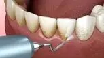 اصلاح یک باور غلط/ جرم‌گیری باعث آسیب به مینای دندان نمی‌شود