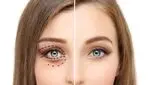 چرا باید ترمیم عمل پلک داشته باشیم؟