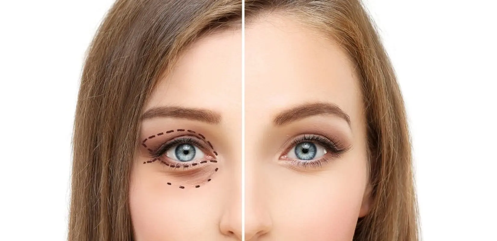 چرا باید ترمیم عمل پلک داشته باشیم؟