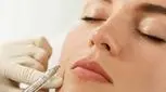 بایو فیلر چیست؟ مزایای بایو فیلر در مقایسه با ژل