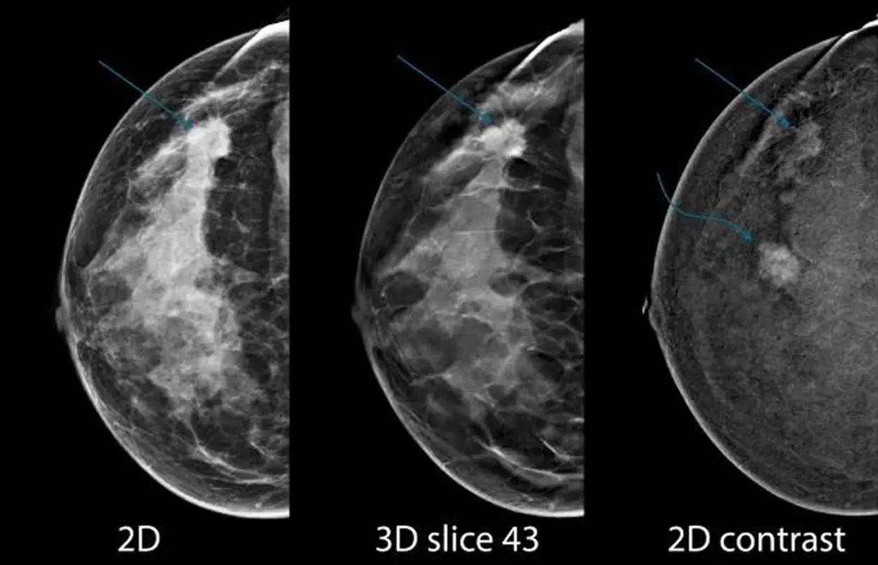 ماموگرافی هالوژیک چه کاربردهایی دارد؟