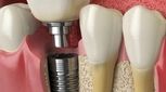 مراحل ایمپلنت دندان چیست؟