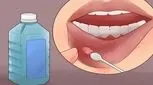 آفت دهان چرا به سراغ ما می آید؟ 