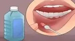 آفت دهان چرا به سراغ ما می آید؟ 