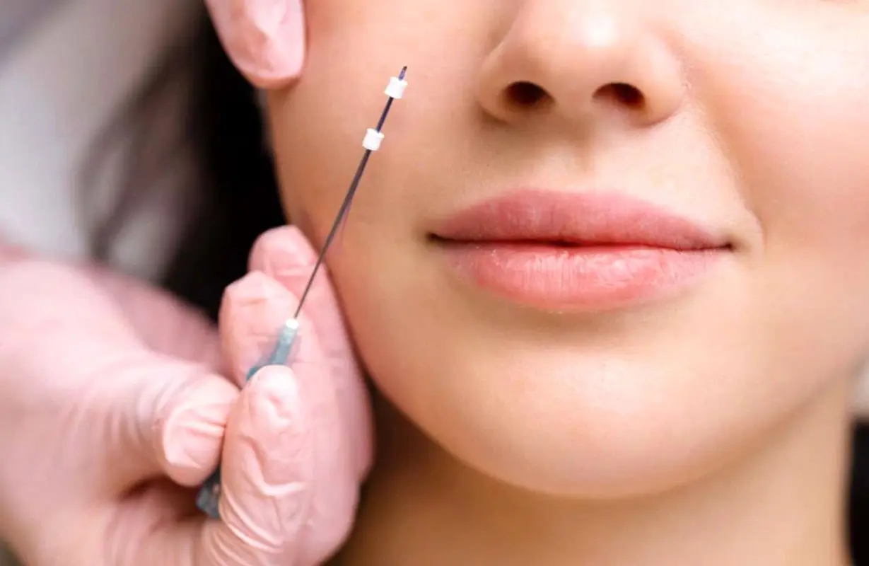 لیفت صورت با نخ  و لیزراندولیفت