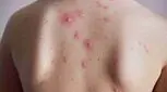 آبله‌مرغان چند روز واگیر دارد؟