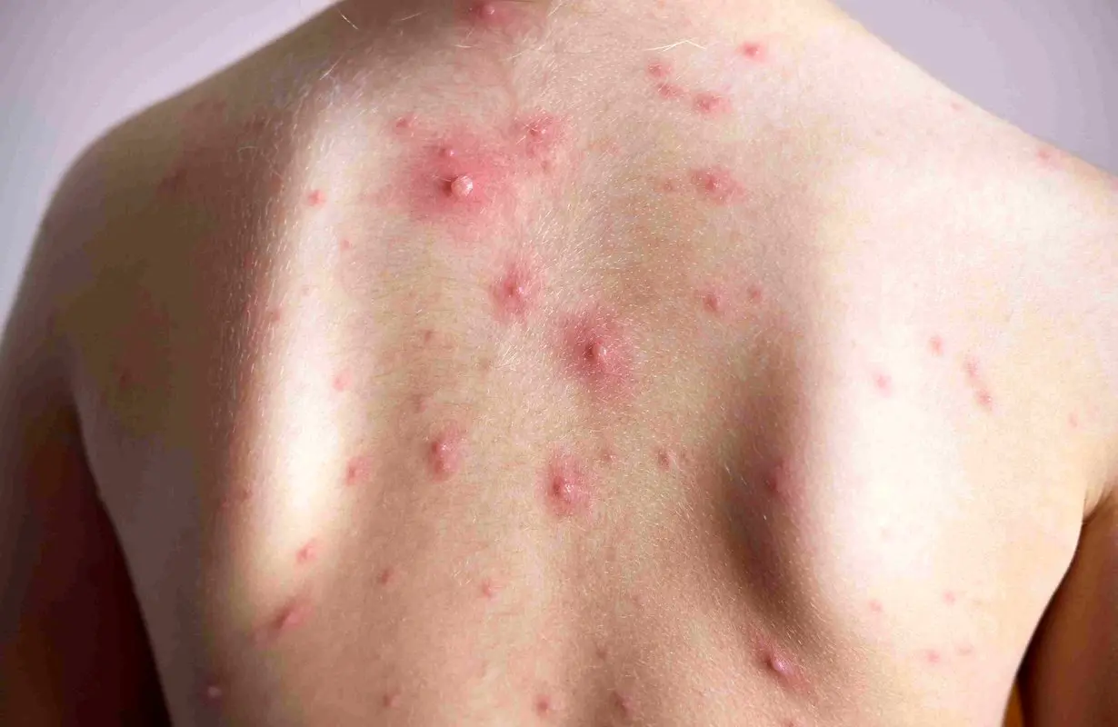 آبلهمرغان چند روز واگیر دارد؟