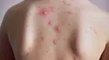 آبله‌مرغان چند روز واگیر دارد؟