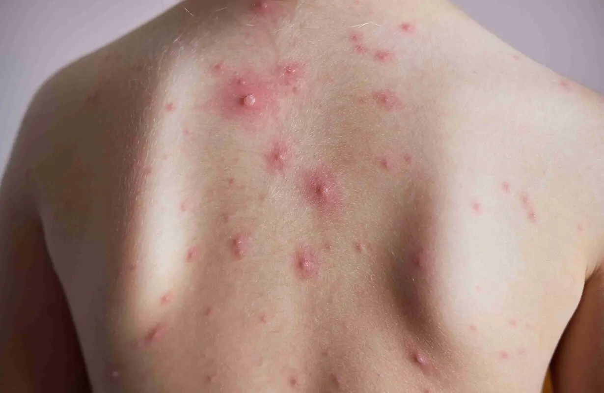 آبله‌مرغان چند روز واگیر دارد؟
