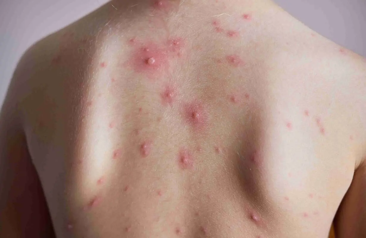 آبله‌مرغان چند روز واگیر دارد؟