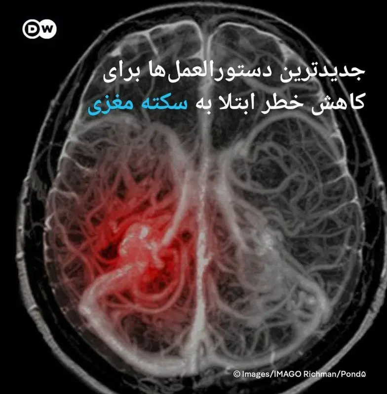 بهروزرسانی دستورالعملهای کاهش خطر سکته مغزی توسط انجمن سکته مغزی آمریکا
