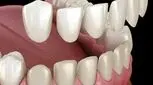 هزینه لمینت سرامیکی دندان چقدر است؟ بررسی قیمت و کیفیت