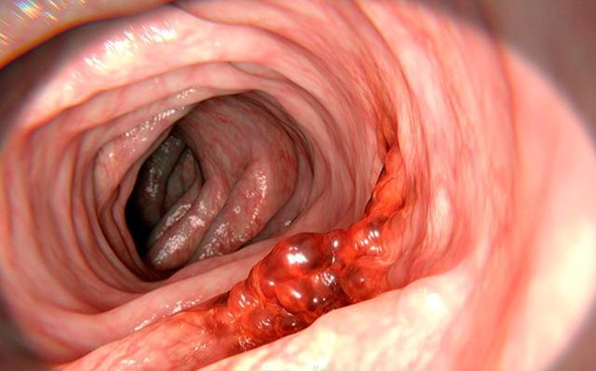 علائم سرطان روده بزرگ را جدی بگیرید 