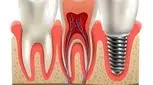 آیا برای ایمپلنت ریشه دندان لازم است؟ بررسی امکان ایمپلنت روی ریشه دندان