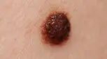 خال سرطانی چیست و چرا خال سرطانی می‌شود؟