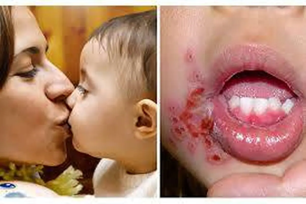 هرگز کودکان خردسال را نبوسید/ ویروس تبخال باعث تشنج و حتی مرگ می‌شود