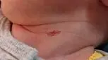 بثورات گردن نوزاد، علل، علائم، پیشگیری و درمان!
