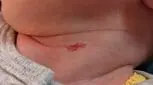 بثورات گردن نوزاد، علل، علائم، پیشگیری و درمان!