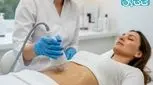 لاغری با مزوتراپی؛ روشی ساده‌تر نسبت به جراحی برای کاهش چربی‌های موضعی