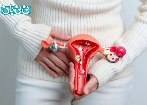 بعد از پاره شدن کیست تخمدان چه باید کرد؟ 6 علائم و درمان