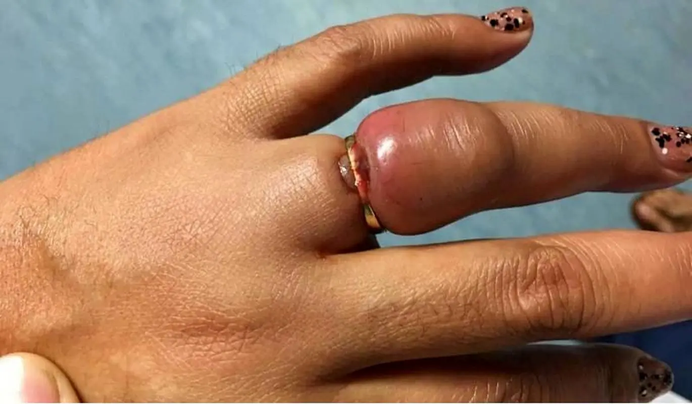 چگونه انگشتری را که در انگشت گیر کرده آزاد کنیم؟