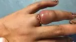 چگونه انگشتری را که در انگشت گیر کرده آزاد کنیم؟