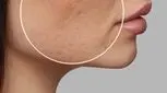 از بین بردن جای زخم و بخیه با لیزر، هر آنچه باید بدانید!