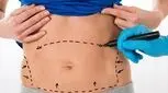 ابدومینوپلاستی چیست و هزینه آن چقدر است؟