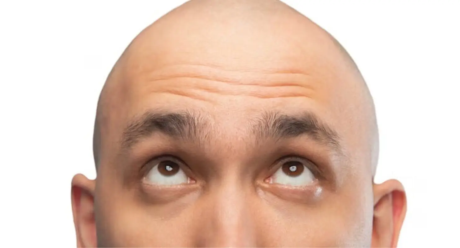 آیا این درست است که طاسی الگوی مردانه از مادر به ارث می‌رسد؟