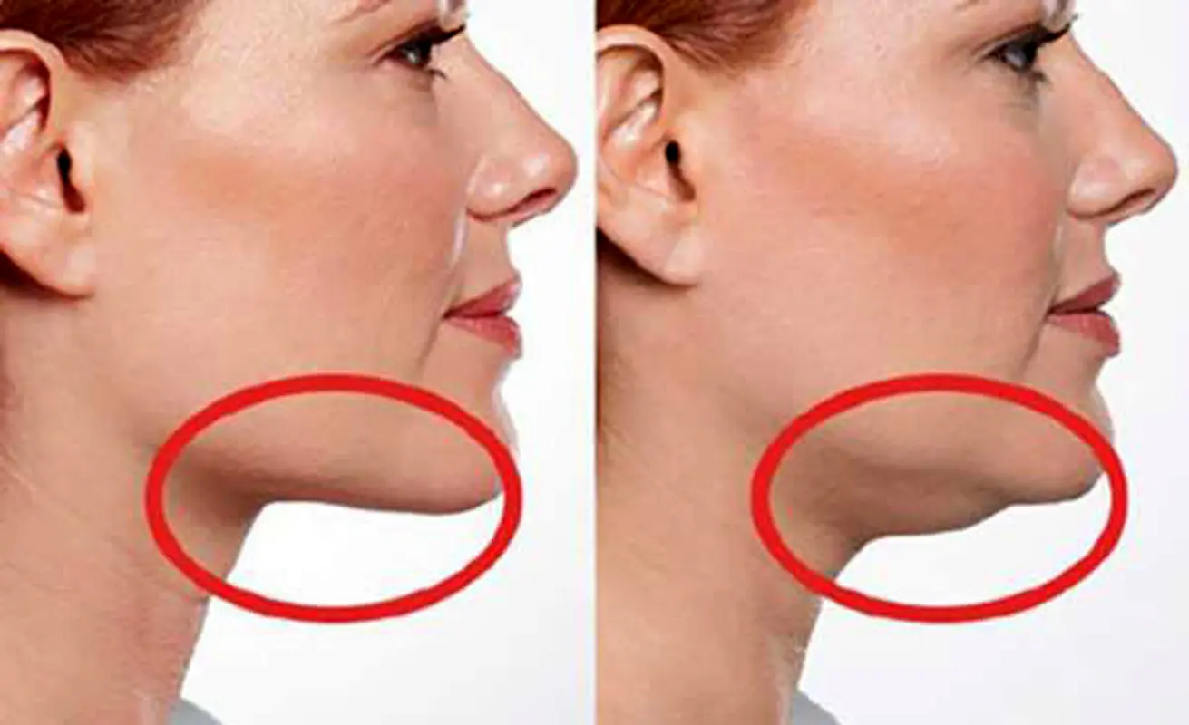 با غبغب چکار کنیم؟  / راه های درمان با انواع جراحی 