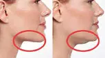 با غبغب چکار کنیم؟  / راه های درمان با انواع جراحی 