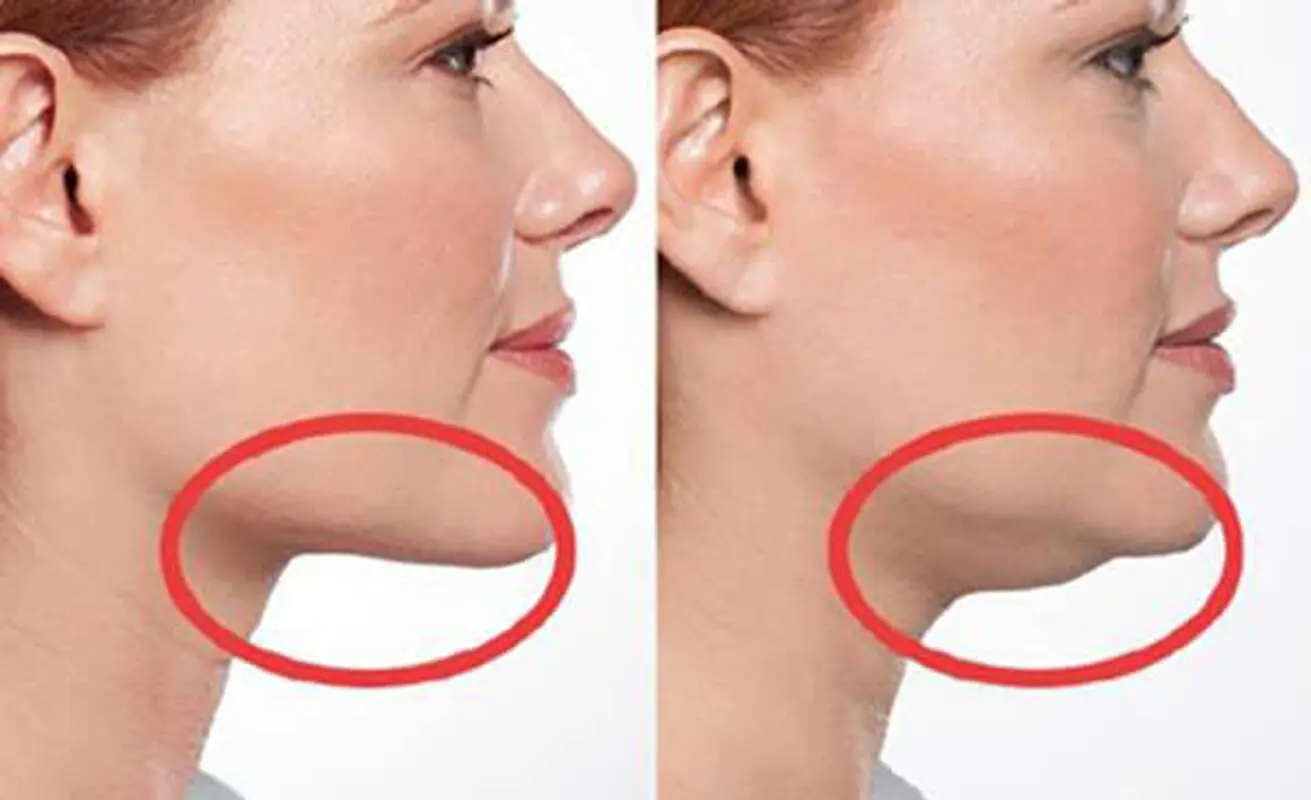 با غبغب چکار کنیم؟  / راه های درمان با انواع جراحی 