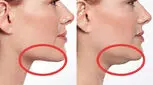 با غبغب چکار کنیم؟  / راه های درمان با انواع جراحی 