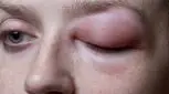 آلرژی و حساسیت به بوتاکس