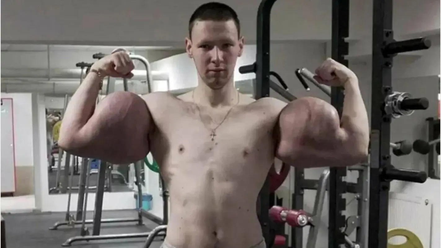 اتفاق تلخ برای بدنساز روس؛ تزریق ژل او را در آستانه قطع دست‌ها قرار داد (عکس)