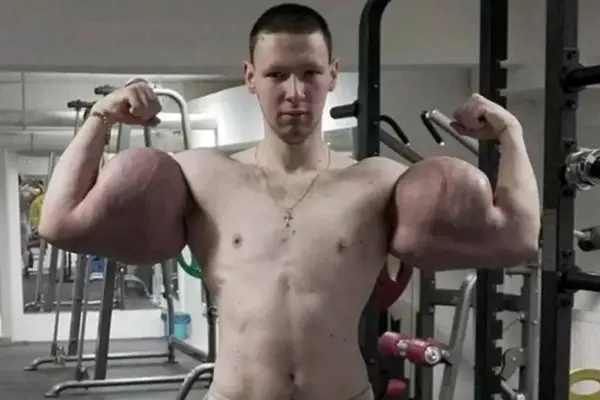 اتفاق تلخ برای بدنساز روس؛ تزریق ژل او را در آستانه قطع دست‌ها قرار داد (عکس)