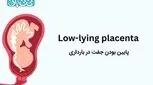 پایین بودن جفت در بارداری ـ ۴ علامت آن و عوارض + راهکارهایی برای بالا رفتن جفت