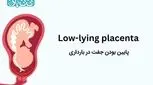 پایین بودن جفت در بارداری ـ ۴ علامت آن و عوارض + راهکارهایی برای بالا رفتن جفت